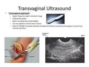 Ultrassom transvaginal: o que é, para que serve e quando fazer