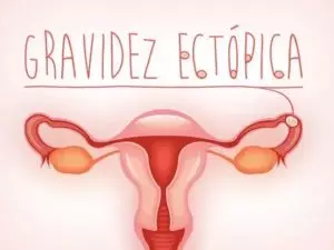 Menstruação na gravidez: principais causas e o que fazer