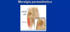 Meralgia parestésica: o que é, sintomas e como tratar