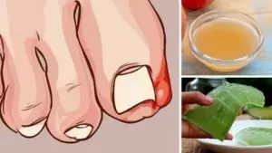 5 Remédios caseiros para pés e mãos inchadas