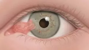 O que é quemose no olho e como é feito o tratamento