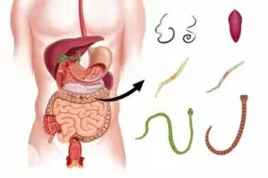 Sintomas que podem indicar vermes intestinais