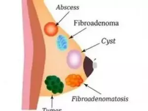 Fibroadenoma e câncer de mama: qual a relação?
