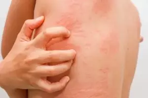 O que é exantema (rash cutâneo), principais causas e tratamento