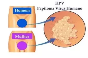 Remédios caseiros para HPV