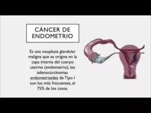 Pólipo endometrial: Dr. Rubens do Val responde! - Clínica Rubens do Val CRM  58764