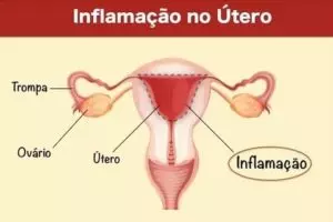 6 sintomas de inflamação no ovário e principais causas