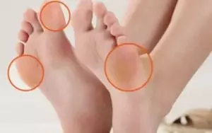 Tratamento caseiro para eliminar calos nos pés