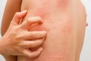 Alergia a corante: principais sintomas e o que fazer