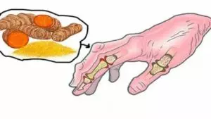 Remédio natural para artrite