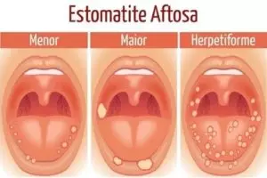 Ferida na língua ou garganta: 5 principais causas e como tratar