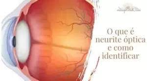 O que é Neurite óptica e como identificar