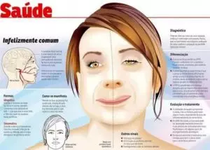 Paralisia facial: o que é, sintomas, principais causas e tratamento