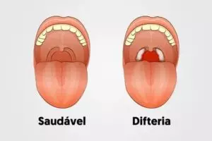 Epiglotite: sintomas, causas e tratamento