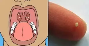 Como eliminar caseum da garganta de forma natural